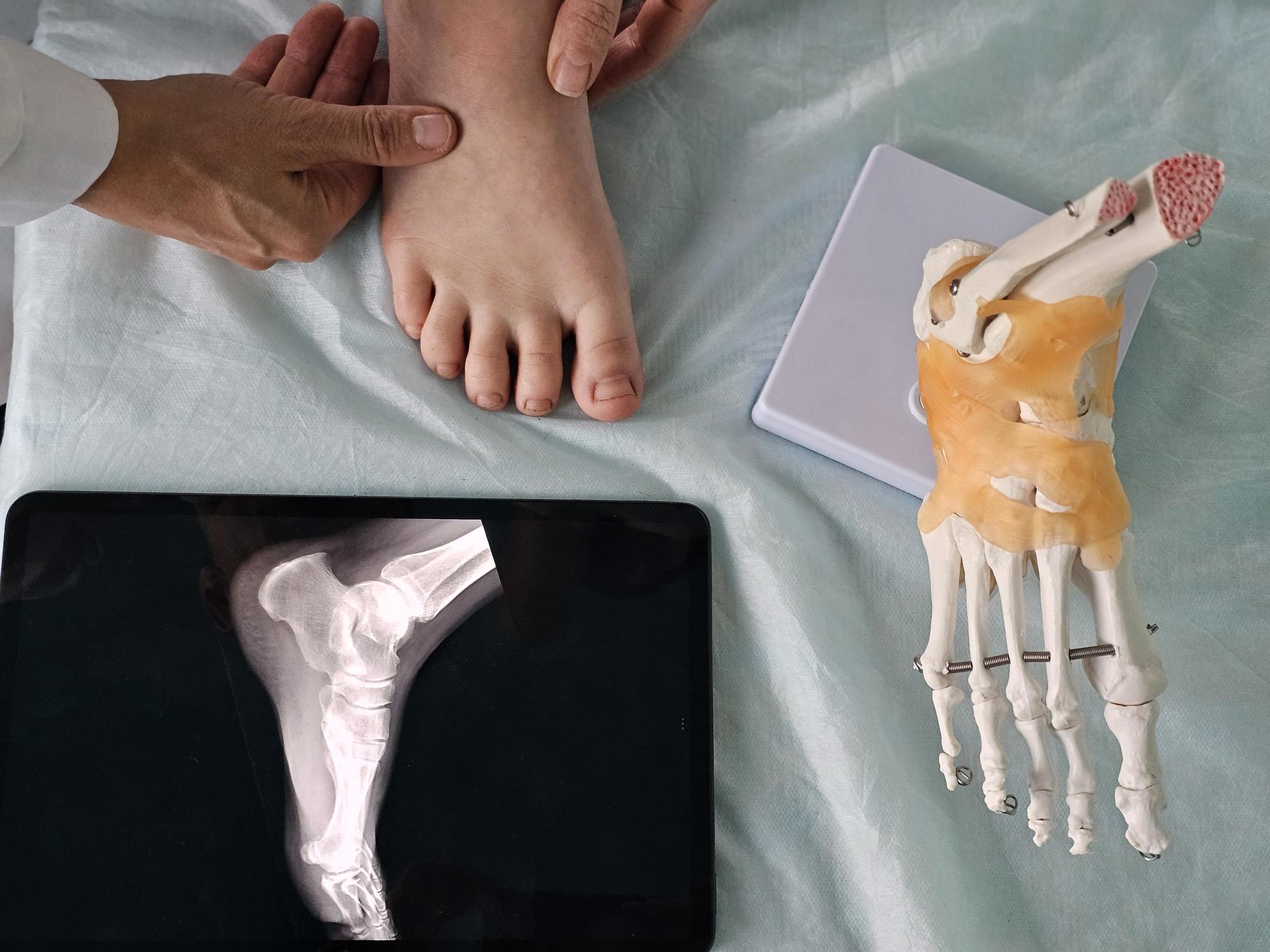 Análisis biomecánico con modelo esquelético del pie